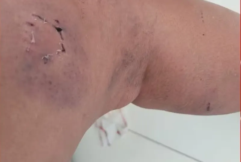 Agente de saúde é atacada por seis cães em Feira de Santana