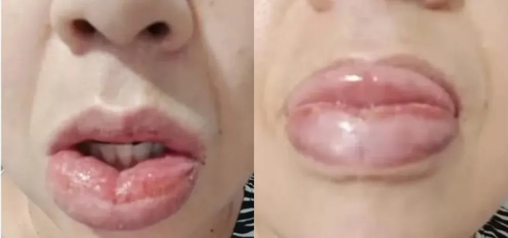 Anvisa registra mais de 1,2 mil queixas de reações adversas à pasta da Colgate