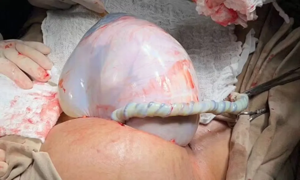 Caso raro na Bahia: bebê nasce dentro da bolsa amniótica, enquanto irmã gêmea não