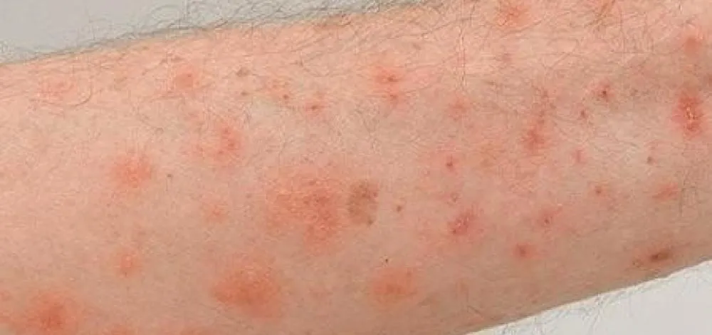 Surto de escabiose é registrado em cidade no interior da Bahia