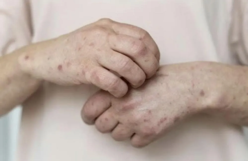 Antônio Cardoso não tem registro de MPOX e Secretaria de Saúde reforça mensagem de tranquilidade