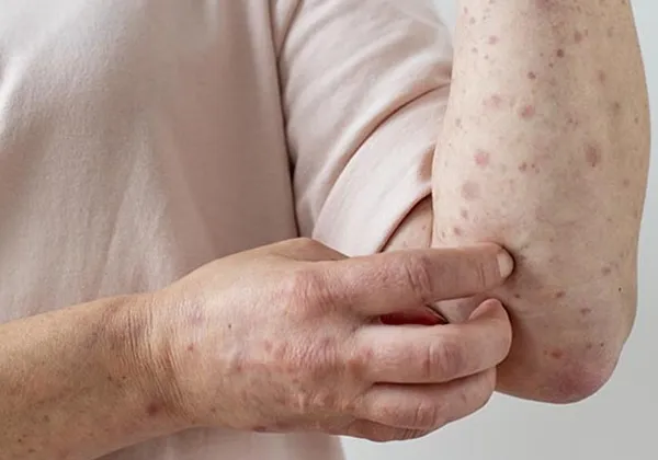 Brasil registra 129 casos confirmados de mpox em 2026