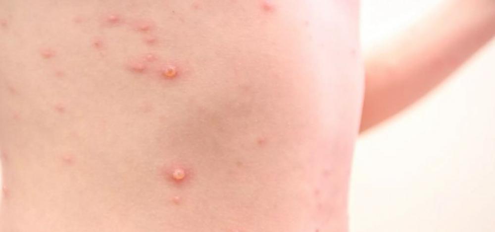 São Gonçalo dos Campos tem caso suspeito de varíola do macaco