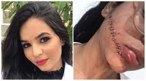 Enfermeira tem rosto cortado durante viajem em ônibus na Bahia