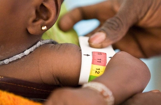 Bahia tem o maior número de internação de bebês por desnutrição