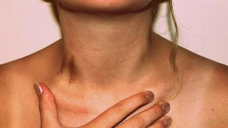 Mulher sofre derrame após receber chupão no pescoço durante sexo