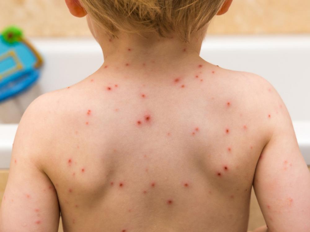 Saúde emite alerta sobre aumento de casos de catapora na Bahia