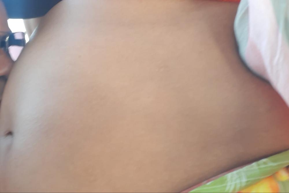 Anvisa orienta suspensão de vacina da AstraZeneca para grávidas