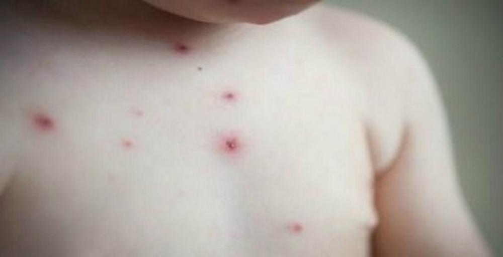 Feira de Santana já registrou mais de 150 casos de catapora