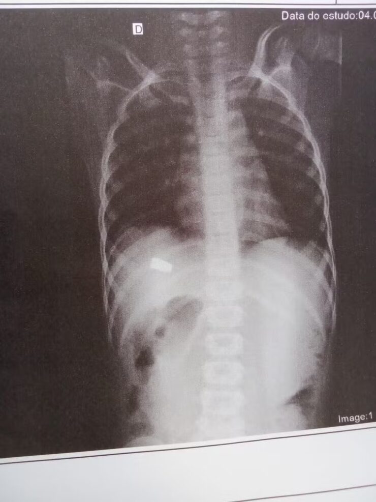 Criança de 8 anos é baleada enquanto brincava na casa da madrinha em Salvador