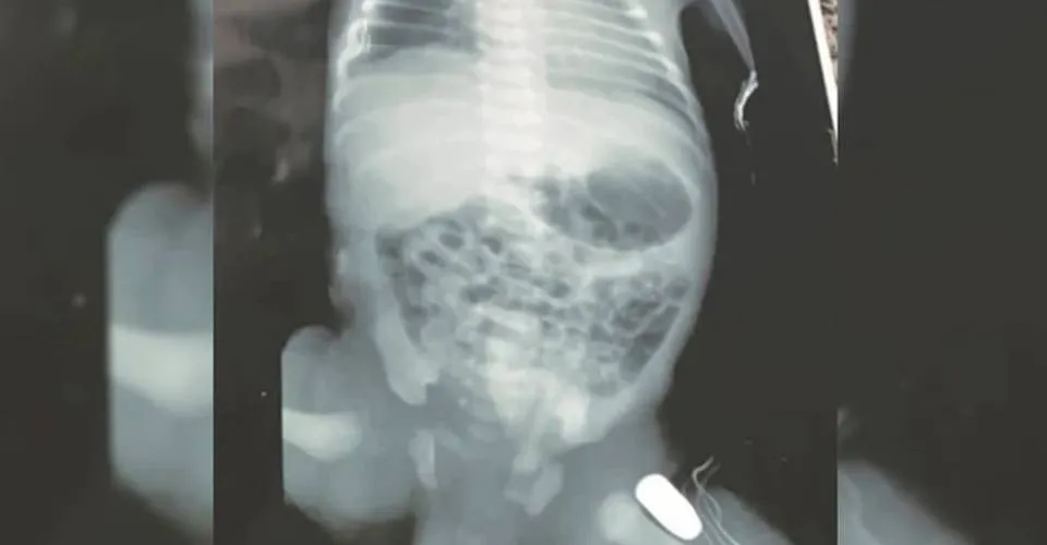 Adolescente grávida é atingida por tiro e bala fica alojada na perna do bebê