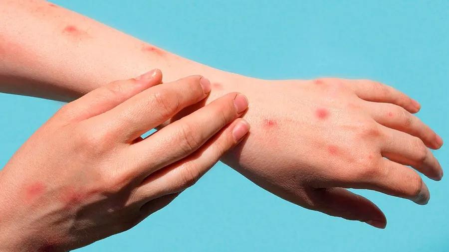 Adolescente de 16 anos com suspeita de mpox é atendido em unidade de saúde de Feira de Santana